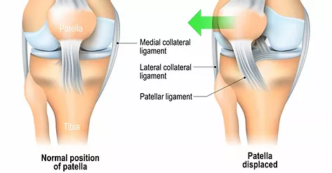 Conservative treatment in acute primary patella dislocation. A